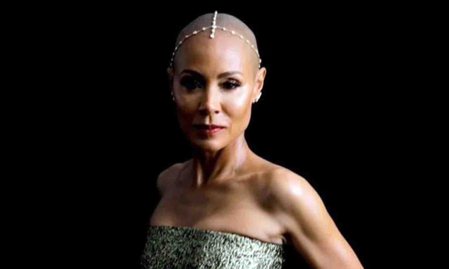 que es alopecia