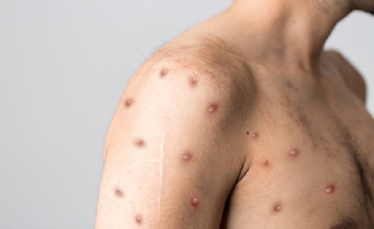 viruela mono pandemia
