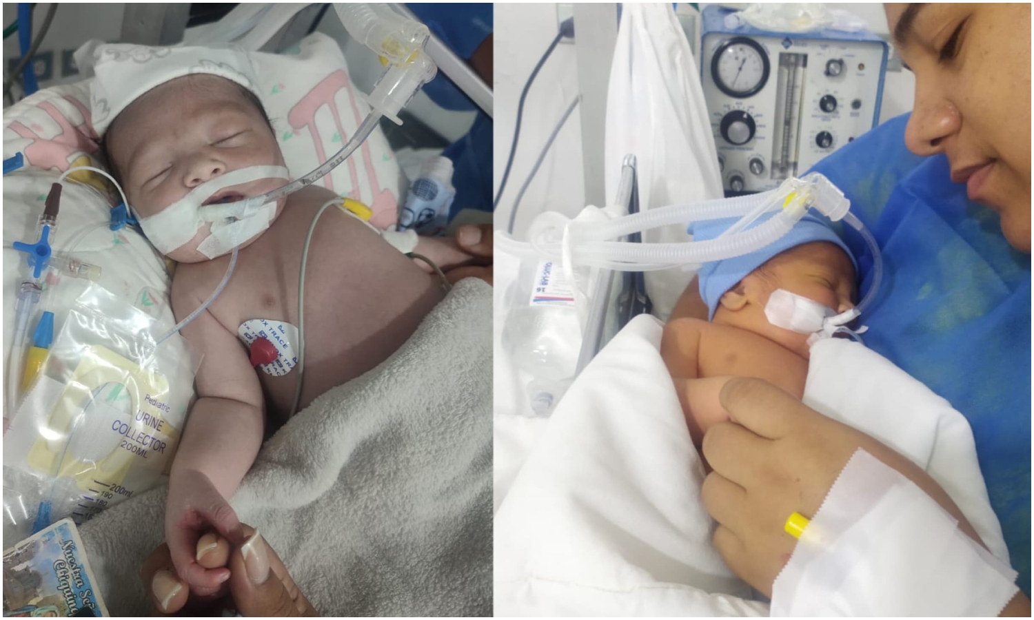 Ayudemos a Gilberto Enrique: el bebé nació con hipertensión pulmonar y sus familiares no disponen del dinero suficiente para cubrir su tratamiento