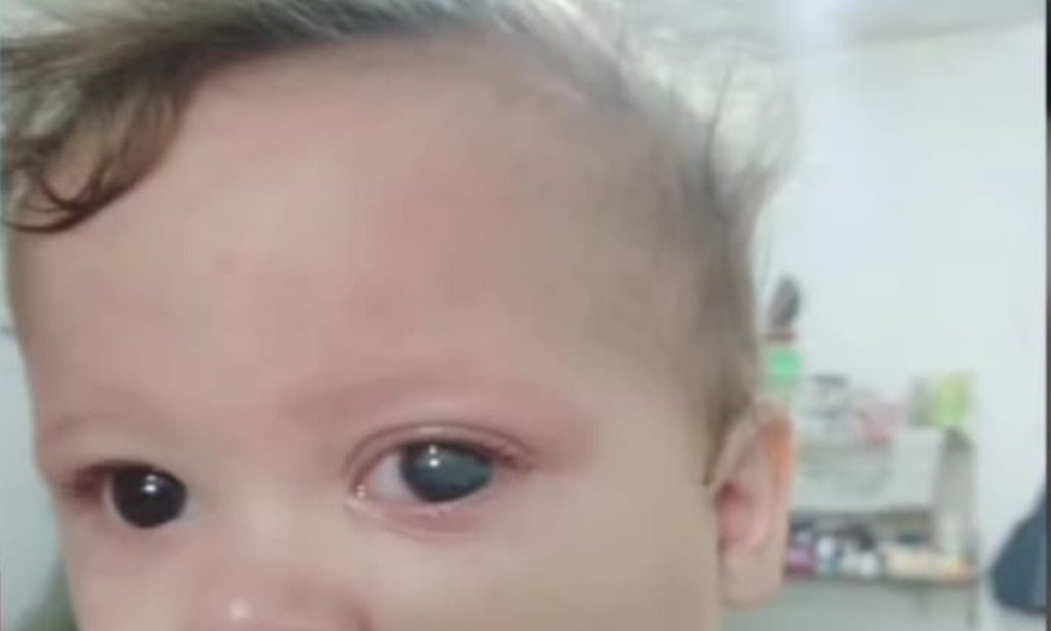 Requieren ayuda para operar urgente a Gustavo Jaziel de 10 meses, diagnosticado con glaucoma secundario