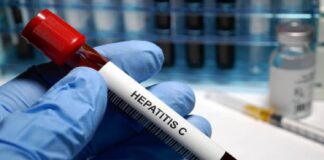 hepatitis c